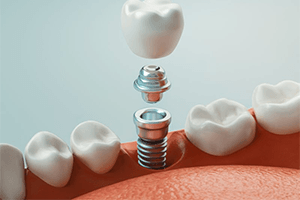 A 3D illustration of a dental implant and crown