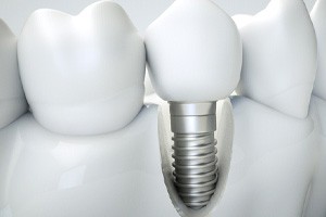 How dental implants work in Tullahoma